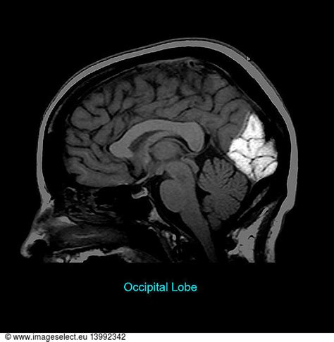 Occipital Lobe Occipital Lobe, Sagittal MRI,brain anatomy,brain,brain ...