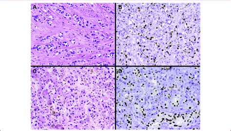 Pathologic Features Of Epithelioid Hemangioendothelioma Ehe Panel