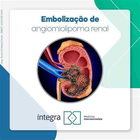 Angiomiolipoma O Que É - Embolização de angiomiolipoma: O que é e quando está indicada?