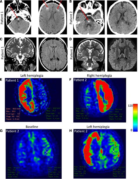 Neuroimaging Of Patients With Hemiplegia A Brain Ct Scan Of Patient