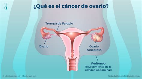 Presentación De Diapositivas Comprender El Cáncer De Ovario