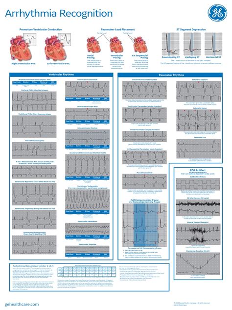 Arrhythmia Recognition Poster Part 2 Pdf Artificial Cardiac