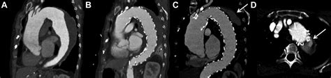 Type Iiib Endoleak After Thoracic Endovascular Aortic Repair Caused By