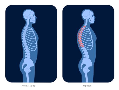 ¿qué Es La Cifosis Tratamientos Y Ejercicios Salud