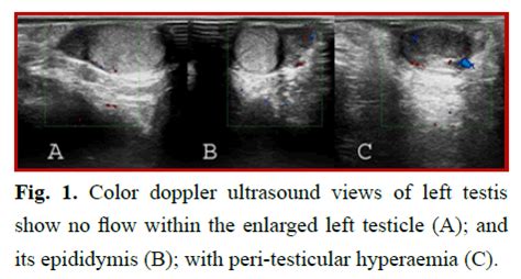 Doppler Signs Of Extravaginal Testicular Torsion Mimicked By Small