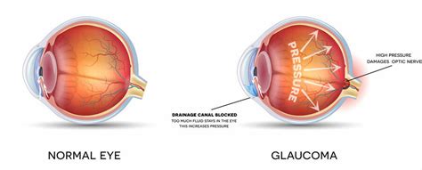 Glaucoma Segunda Causa Común De La Ceguera