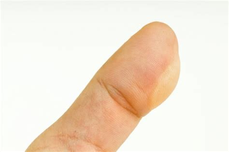 Blisters Causes Treatments And Prevention