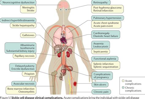 Sickle Cell Anemia Signs And Symptoms