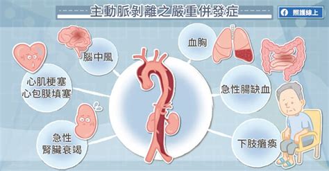 劇痛且要命的主動脈剝離 醫師圖文解說 Ettoday探索 Ettoday新聞雲