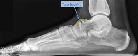 Tarsal Coalition Foot Conditions The London Foot Ankle Clinic