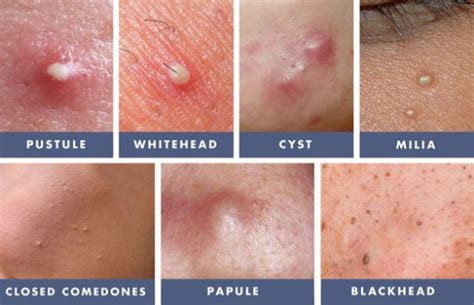 Acne Vulgaris The Sloan Clinics