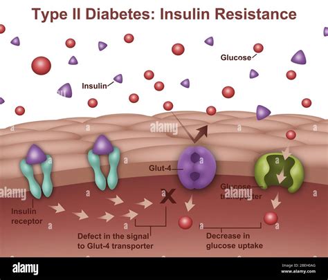 How Common Is Type 2 Diabetes In Australia Coremymages