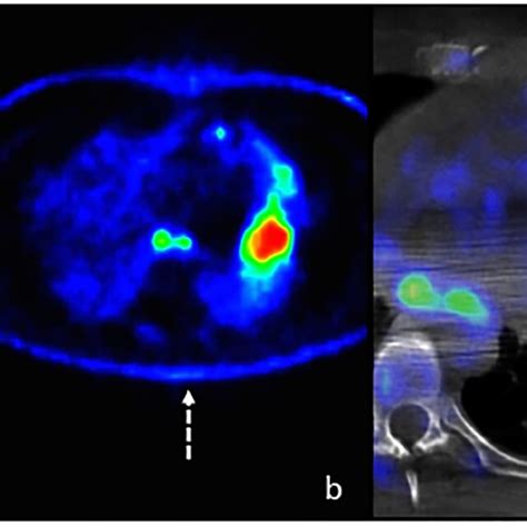 Male Year Old A Avgm Sagittal Arterial Phase Ct Scan Shows A