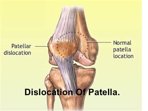 Dislocation Of Patella