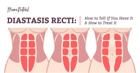 Diastasis Recti Do You Have It Plus How To Treat It Diastasis Recti