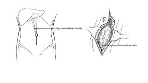 Laparotomy Opening And Closing