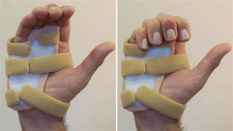 4 Triggerintrinsic Stretch Splint A Volar Hand Based Splint