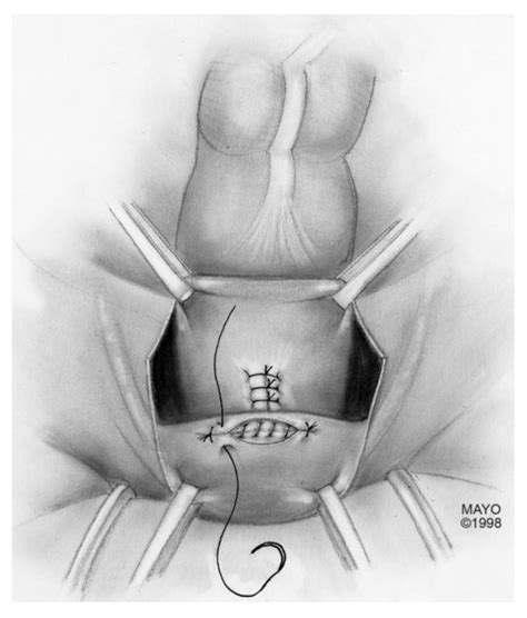 Colorectal Vaginal Fistulas Imaging And Novel Interventional Treatment