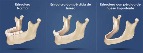 Implantes Dentales Con Poco Hueso En Tarragona Y Reus Alba Cl Nica Dental