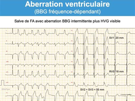 Aberration Ventriculaire BBD Ou BBG E Cardiogram