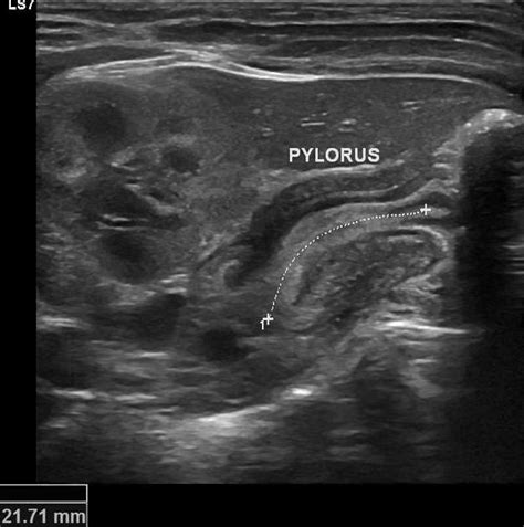 Pyloric Stenosis Ultrasound