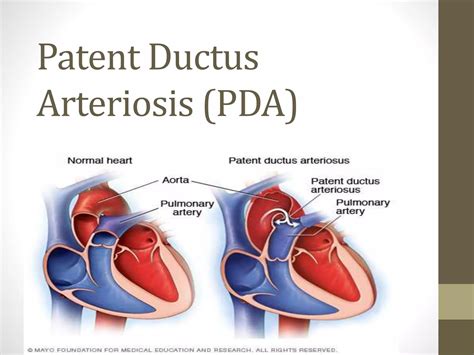 Patent Ductus Arteriosis Discuss Pptx