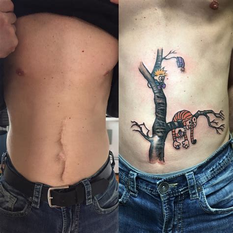 Calvin Andhobbes Surgical Scar Cover Up By Dana Carnegie At True Love Tattoo In Londonontario