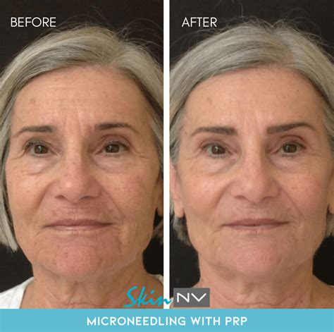 Tampa VirtueRF Microneedling Skin NV South Tampa