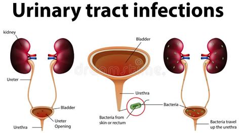 Ilustración Informativa De Infecciones Del Tracto Urinario Ilustración Del Vector Ilustración