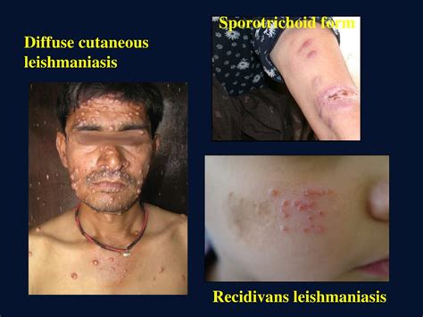 Ppt Leishmaniasis Powerpoint Presentation Free Download Id4596988