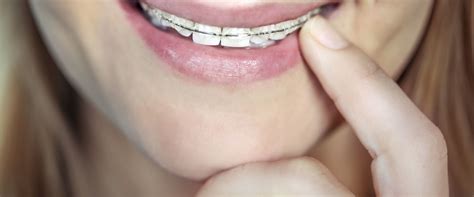 How Much Does it Cost to Get Braces?