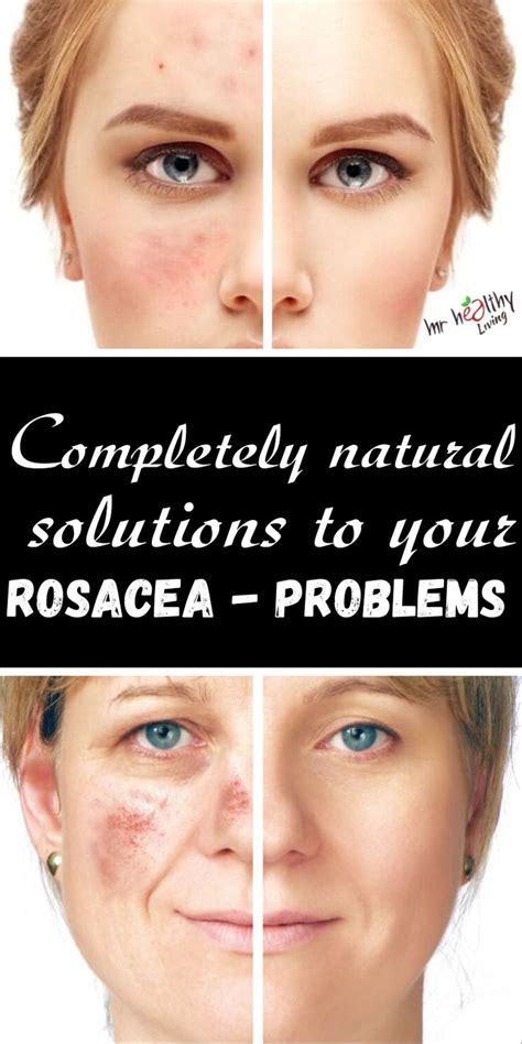 Completely Natural Solutions To Your Rosacea Problems Natural Skin