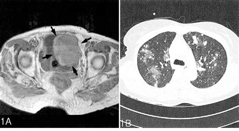 Benign Glomus Tumor Semantic Scholar