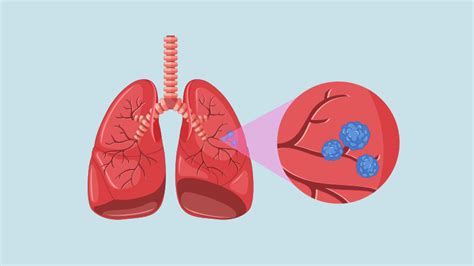 ¿cómo Funcionan Los Pulmones Roche Pacientes