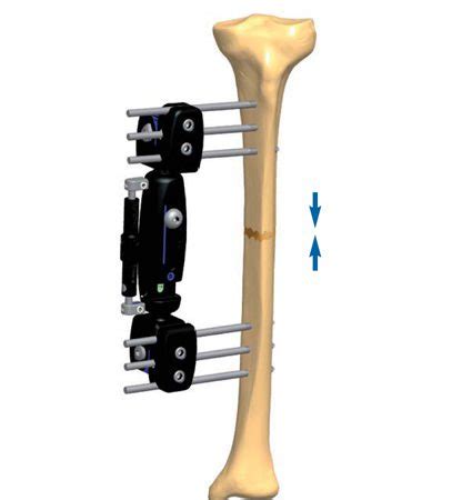 Tibial Non Union Treatment Orthofix ABS