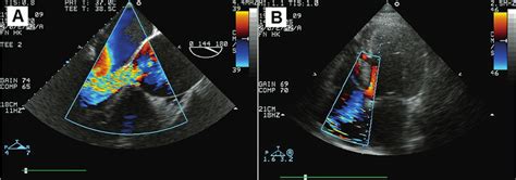 A A Preoperative Transesophageal Echocardiogram With Colour Doppler