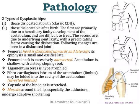 Congenital Hip Dislocation PPT