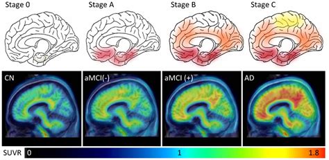 Representative Sagittal 18F AV 45 PET Images Varying Degrees Of