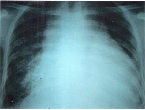 Chest Radiograph Postero Anterior View Showing Mediastinal Widening