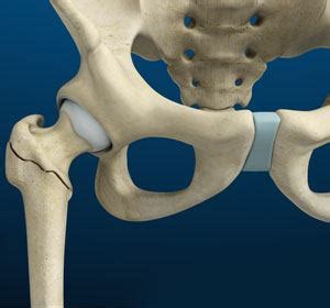 Subtrochanteric Hip Fracture Washington Dc Hip Fractures Washington Dc