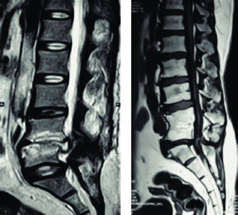 Conservative Treatment Of Discitis Showed Fusion Of Vertebral Bodies