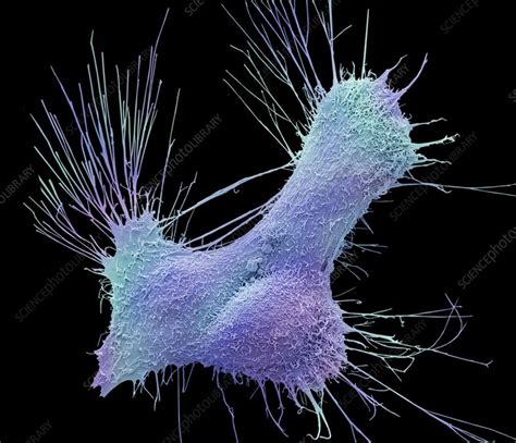 Prostate Cancer Cells SEM Stock Image C022 6987 Science Photo