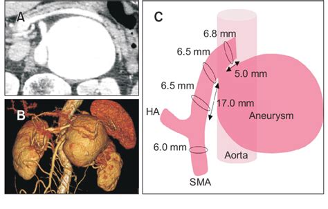 Figure 1 From Giant Superior Mesenteric Artery Aneurysm Treated By