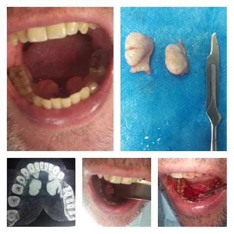 Torus Mandibular - CIRURGIA BUCOMAXILOFACIAL