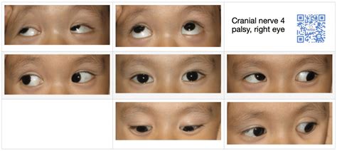 Cranial Nerve Palsy 3rd Nerve Palsy 4th Nerve Palsy 6th Nerve Palsy