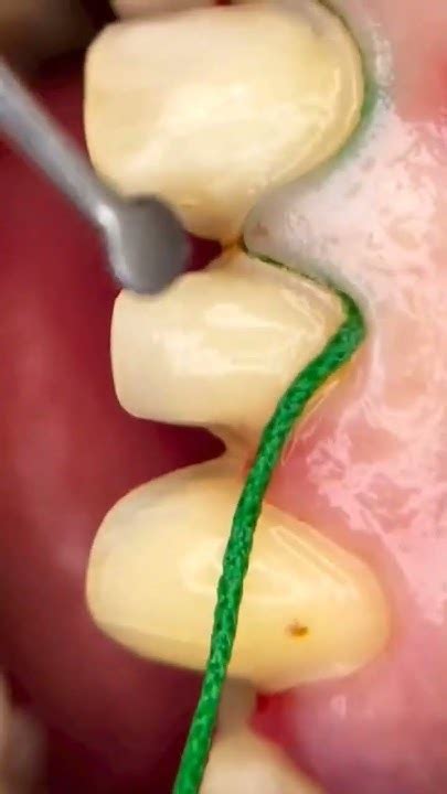 Retraction Cordpreparation Teeth تحضير الاسنان لأخد الطبعة Youtube