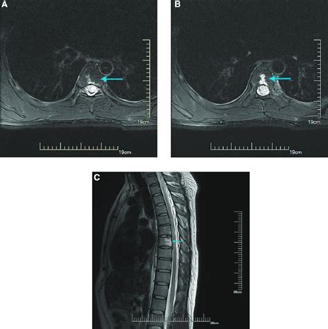 Axial MRI T2WI Sequence Showing High Signal Lesion In T7 Spinal Cord