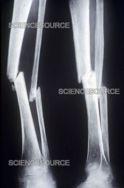 Photograph | Fractured Tibia and Fibula, X-ray | Science Source Images