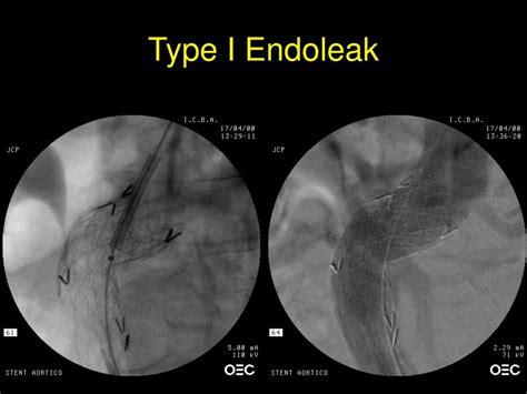 Ppt Endoleaks Graft Extension Or Coil Embolization Powerpoint Presentation Id 4247120