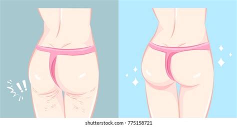 Woman Buttocks Before After Cellulite On Stock Illustration